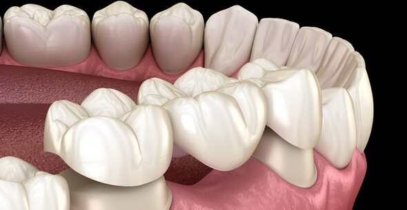 Dental Bridge Treatments At Durrheim And Associates Dental Clinic In Marlborough NZ