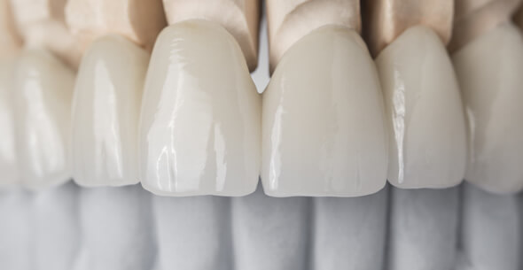 Dental Crown Treatments At Durrheim And Associates Dental Clinic In Marlborough NZ