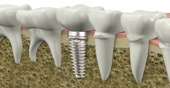Dental Implants At Durrheim And Associates Dental Clinic In Marlborough NZ