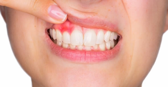 Gingivitis Treatments At Durrheim And Associates Dental Clinic In Marlborough NZ