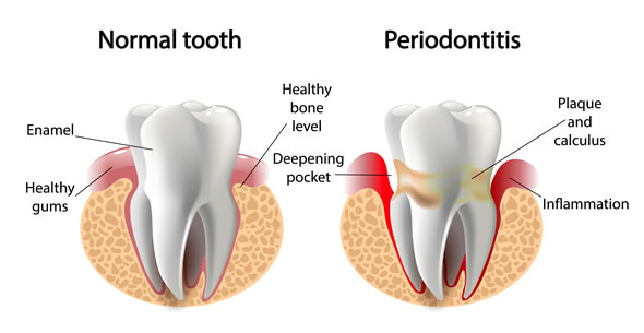 Gum Disease Treatments At Durrheim And Associates Dental Clinic In Marlborough NZ