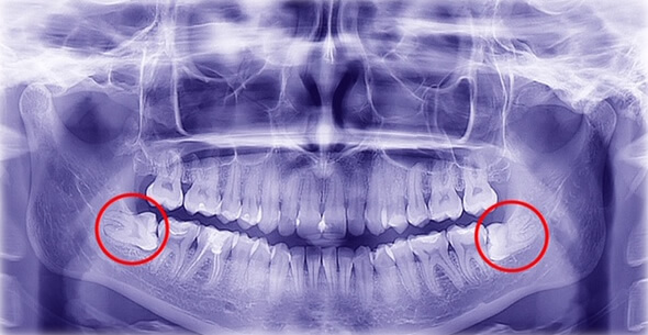 Oral X Ray For Extraction At Durrheim And Associates Dental Clinic In Marlborough NZ