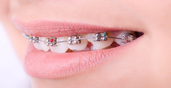 Orthodontics At Durrheim And Associates Dental Clinic In Marlborough NZ