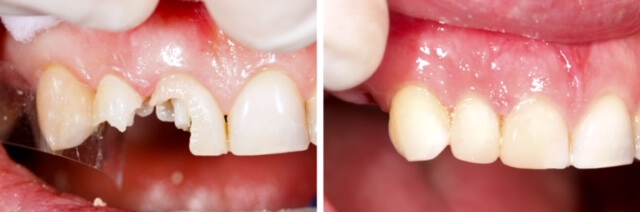 Restorative Dentistry With Composite Fillings At Durrheim And Associates Dental Clinic In Marlborough NZ