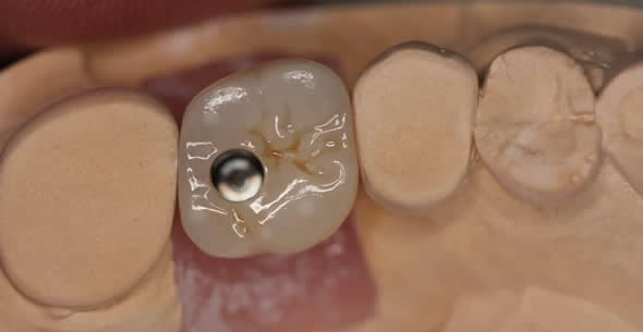 Dental Implant Process 01 At Durrheim And Associates Dental Clinic In Marlborough NZ