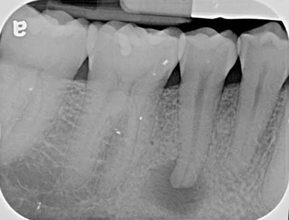 Treatment Of Abscess In Tooth At Durrheim And Associates Dental Clinic In Marlborough NZ
